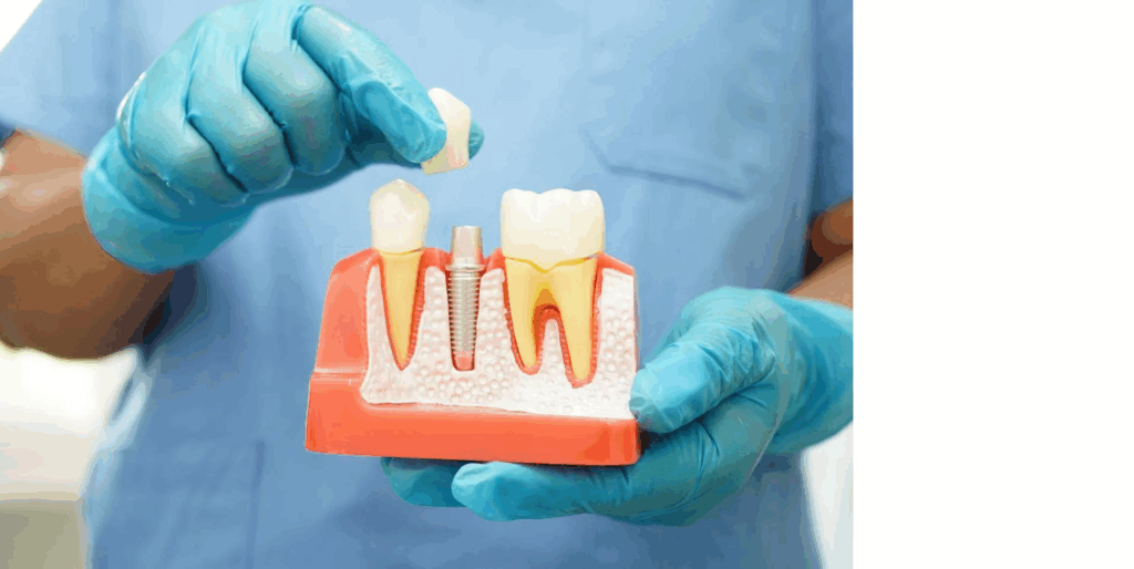Model zubního implantátu